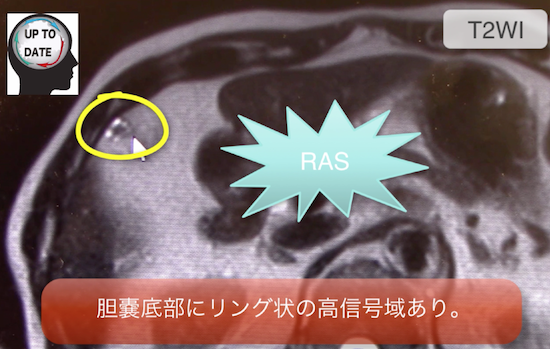 胆嚢腺筋腫症とは？MRIの画像診断のポイントは？RASとは？